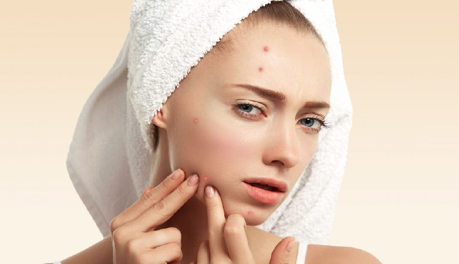 Top 3 Effective Home Remedies to Minimize Acne Existence