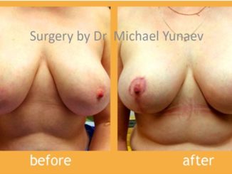 specialize in breast reduction at Breast & Body Clinic