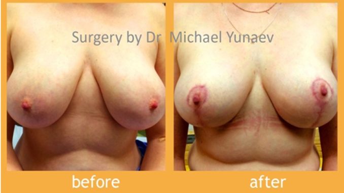 specialize in breast reduction at Breast & Body Clinic