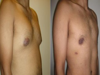 Gynecomastia Operation, The Innovative Surgery To Cure Gynecomastia Has Arrived