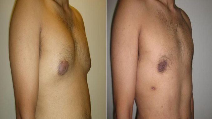 Gynecomastia Operation, The Innovative Surgery To Cure Gynecomastia Has Arrived