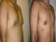 Gynecomastia Operation, The Innovative Surgery To Cure Gynecomastia Has Arrived