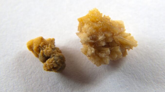 Kidney Stones